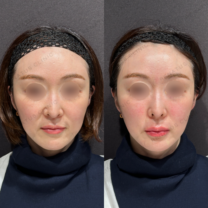 唇ヒアルロン酸ボルベラ症例写真 唇ヒアルロン酸ボルベラ症例写真