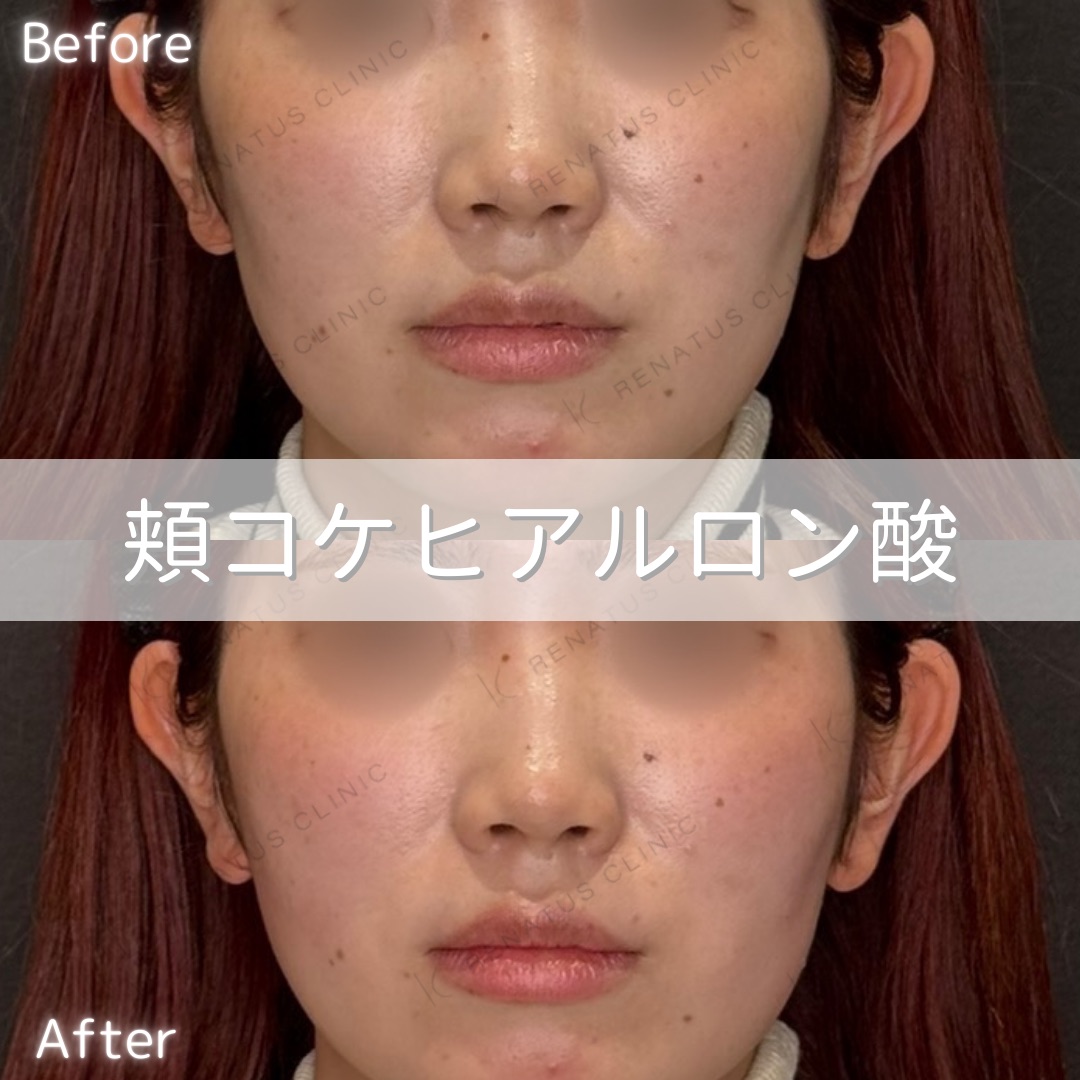 頬コケヒアルロン酸 頬コケヒアルロン酸