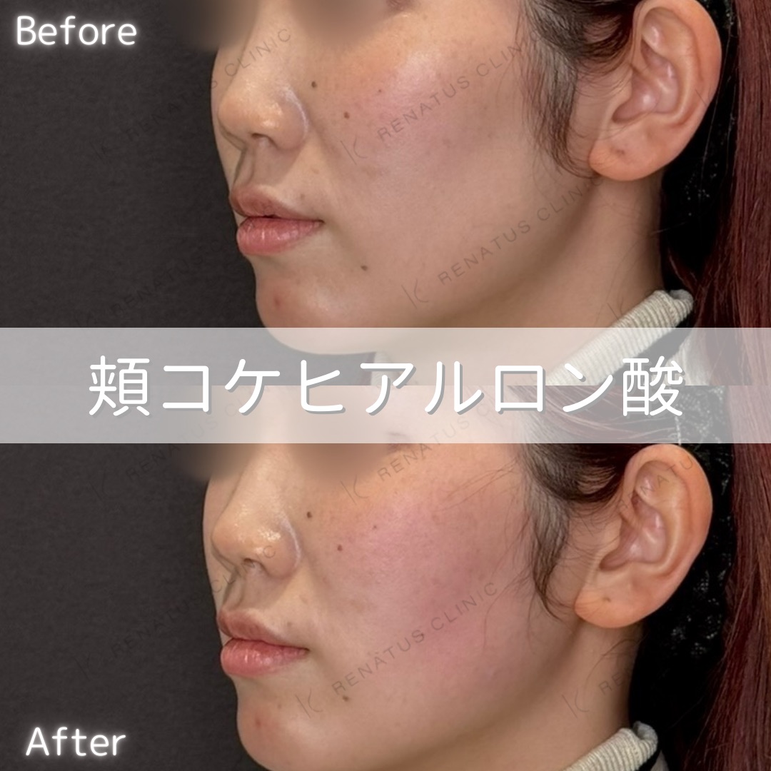 頬コケヒアルロン酸 頬コケヒアルロン酸