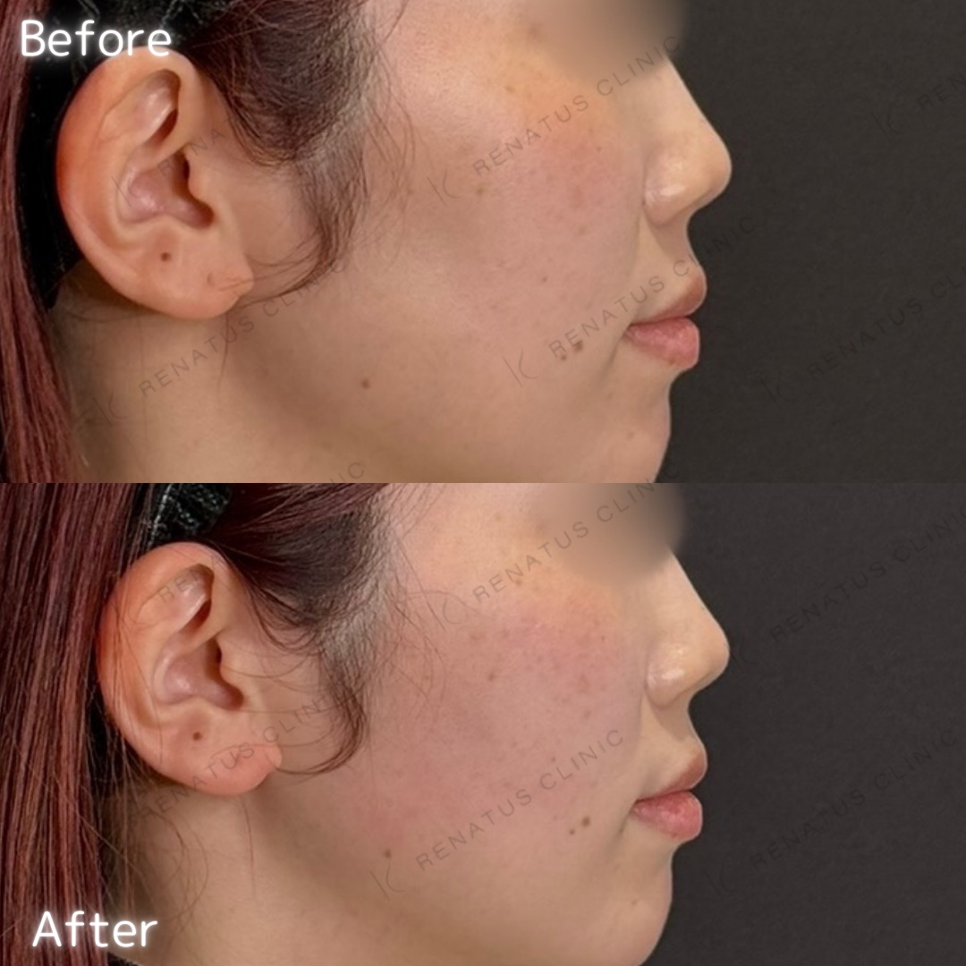 頬コケヒアルロン酸 頬コケヒアルロン酸