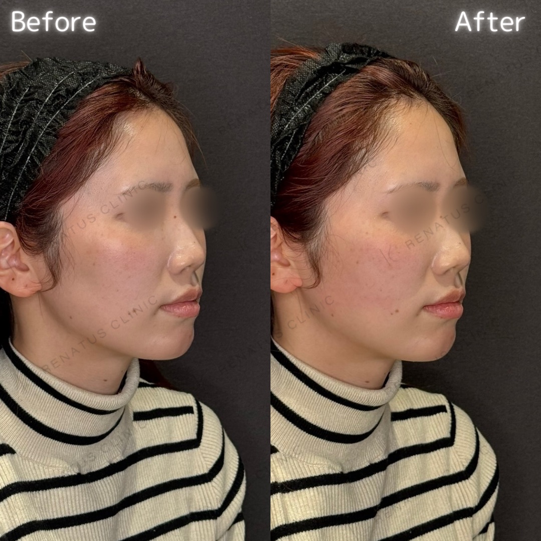 頬コケヒアルロン酸 頬コケヒアルロン酸