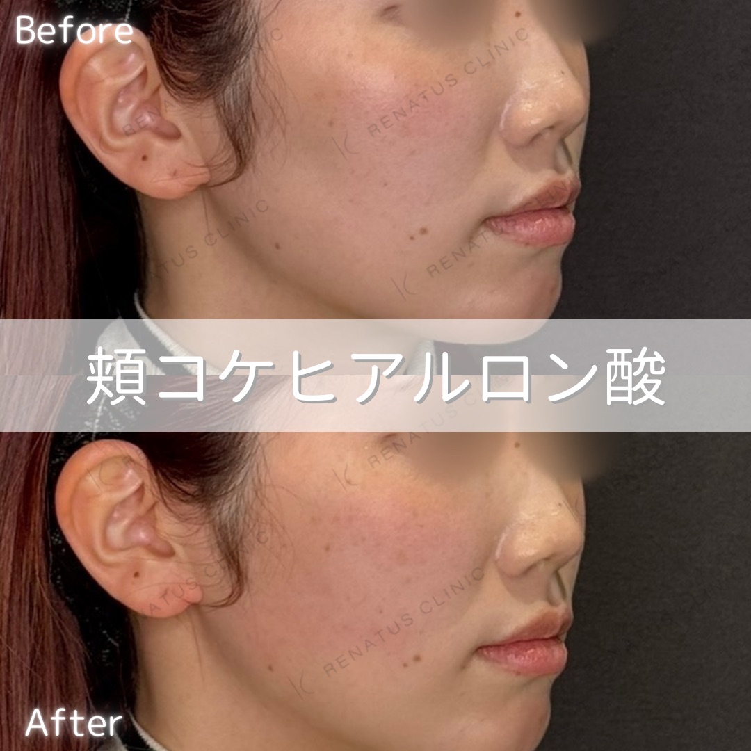 頬コケヒアルロン酸 頬コケヒアルロン酸