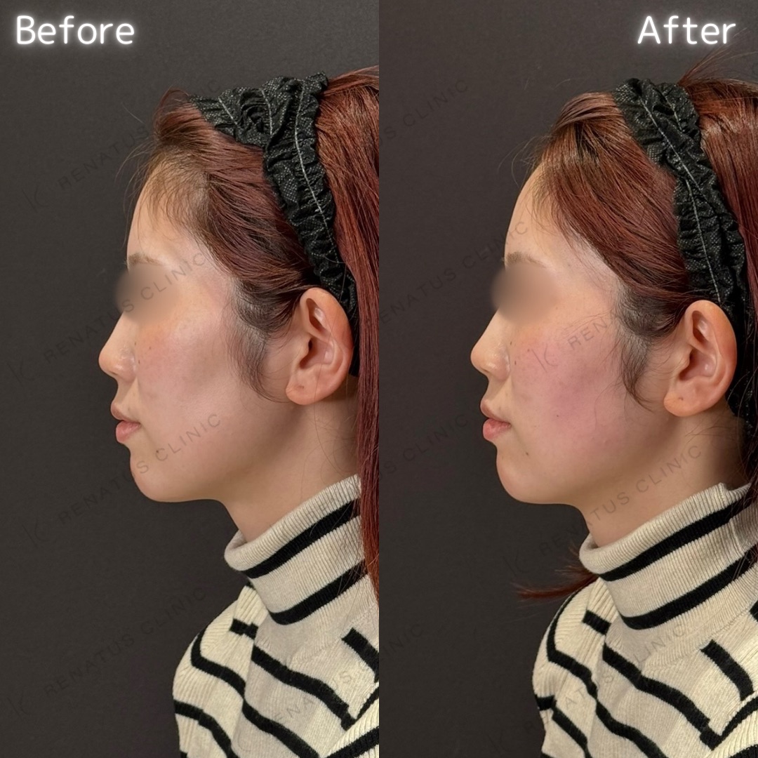 頬コケヒアルロン酸 頬コケヒアルロン酸