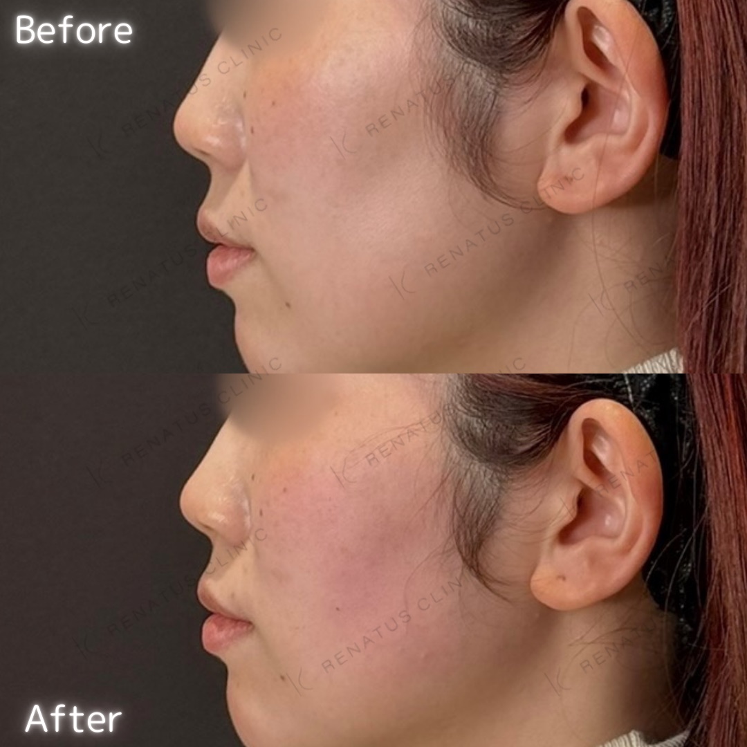 頬コケヒアルロン酸 頬コケヒアルロン酸