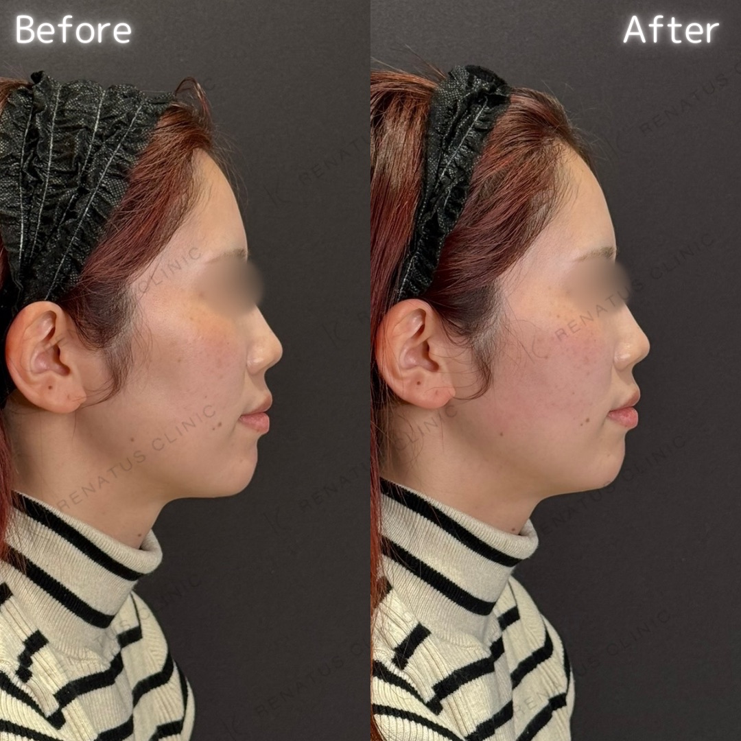 頬コケヒアルロン酸 頬コケヒアルロン酸