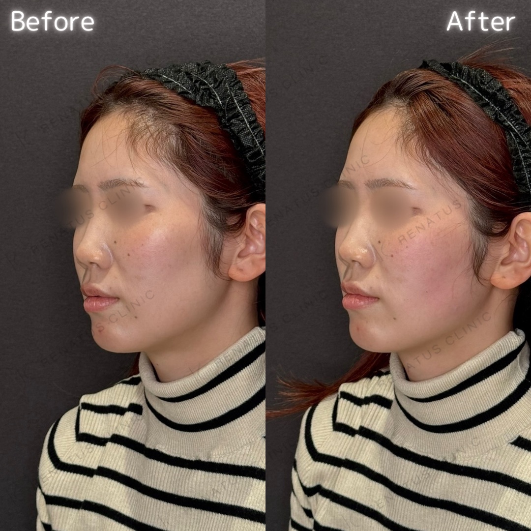 頬コケヒアルロン酸 頬コケヒアルロン酸