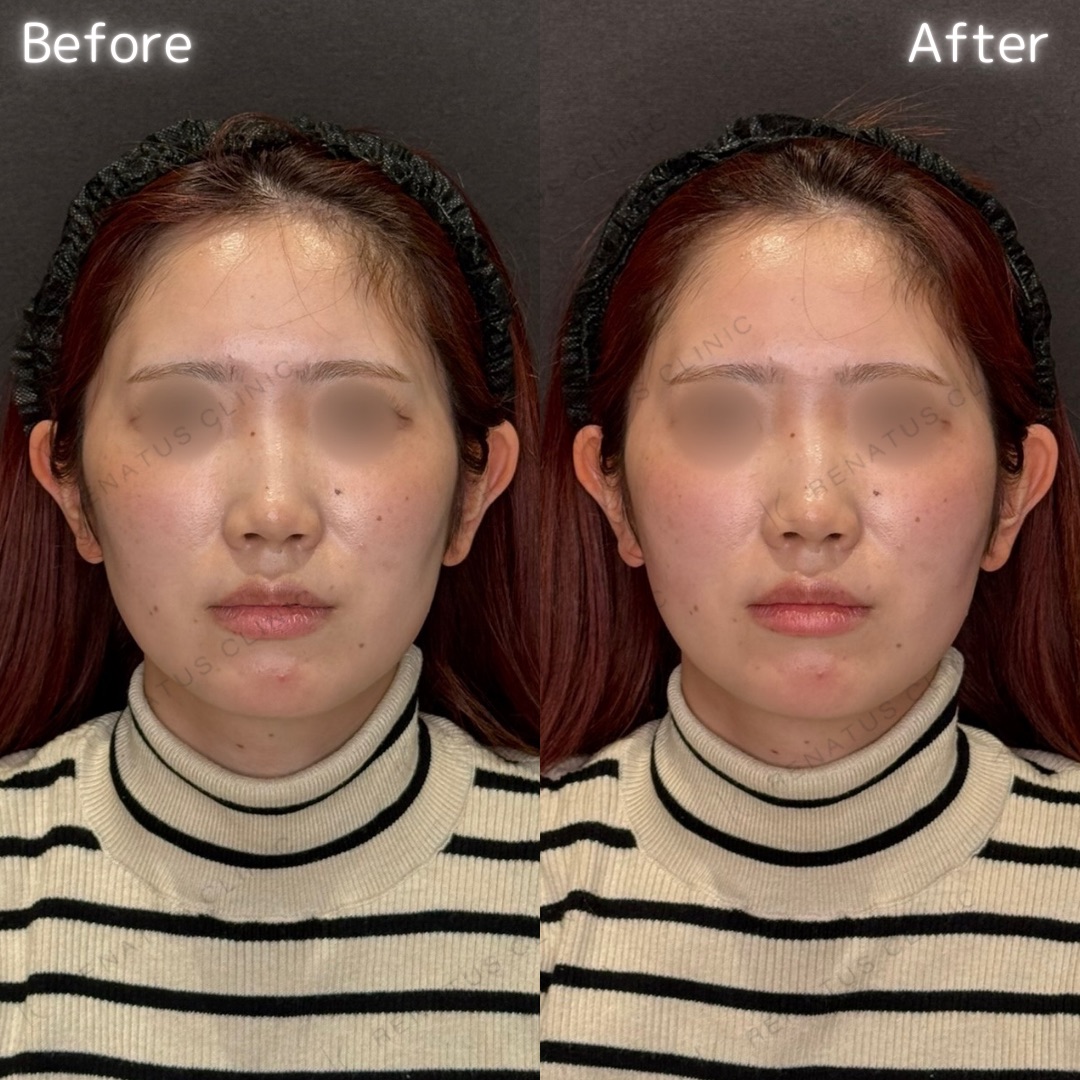 頬コケヒアルロン酸 頬コケヒアルロン酸