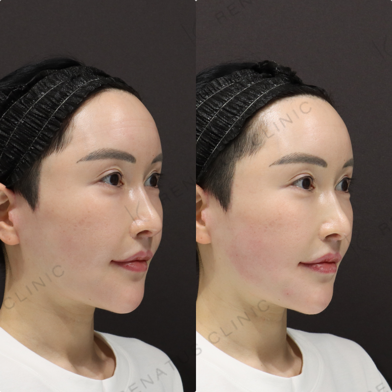 こめかみ・口周りヒアルロン酸症例写真