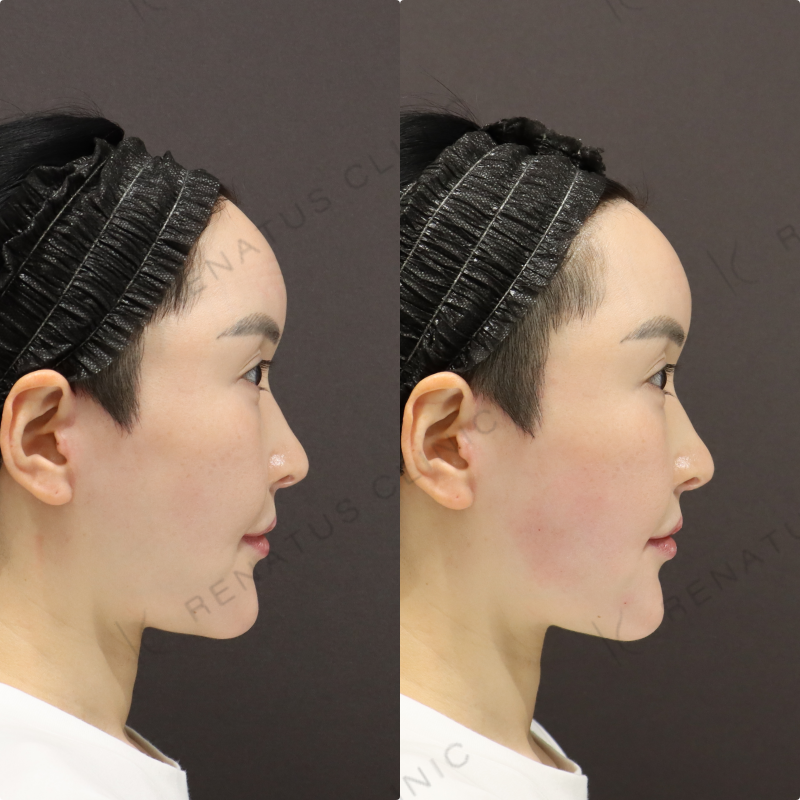 こめかみ・口周りヒアルロン酸症例写真