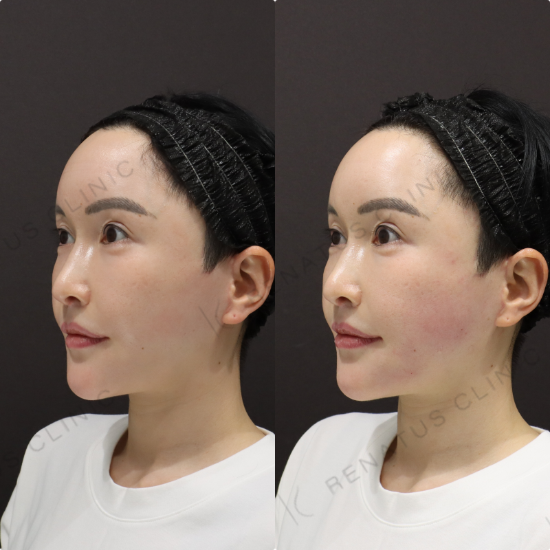 こめかみ・口周りヒアルロン酸症例写真