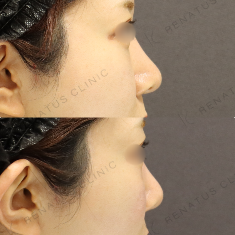 ゴルゴラインヒアルロン酸症例写真