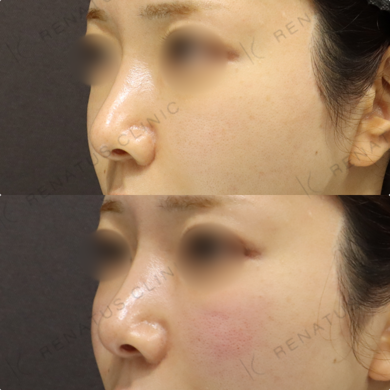 ゴルゴラインヒアルロン酸症例写真