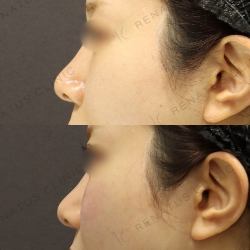 ゴルゴラインヒアルロン酸症例写真