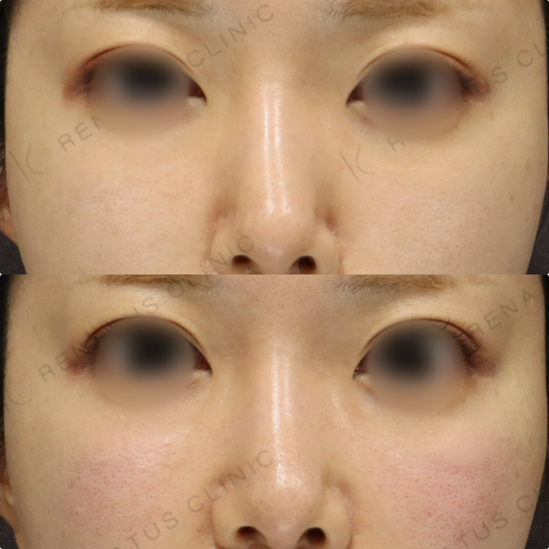 ゴルゴラインヒアルロン酸症例写真