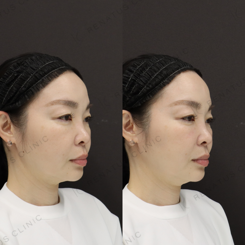 ゴルゴラインヒアルロン酸症例写真