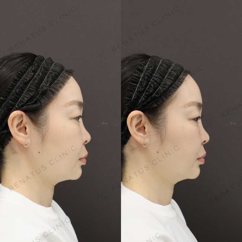 ゴルゴラインヒアルロン酸症例写真