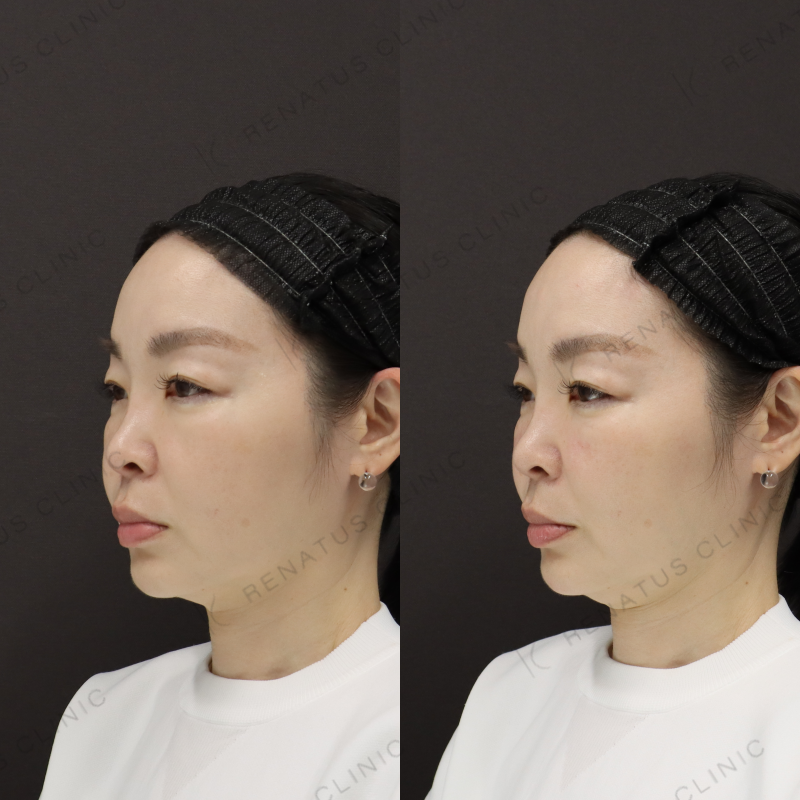 ゴルゴラインヒアルロン酸症例写真