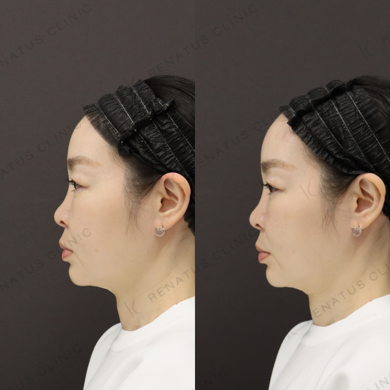 ゴルゴラインヒアルロン酸症例写真