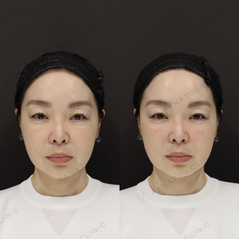 ゴルゴラインヒアルロン酸症例写真