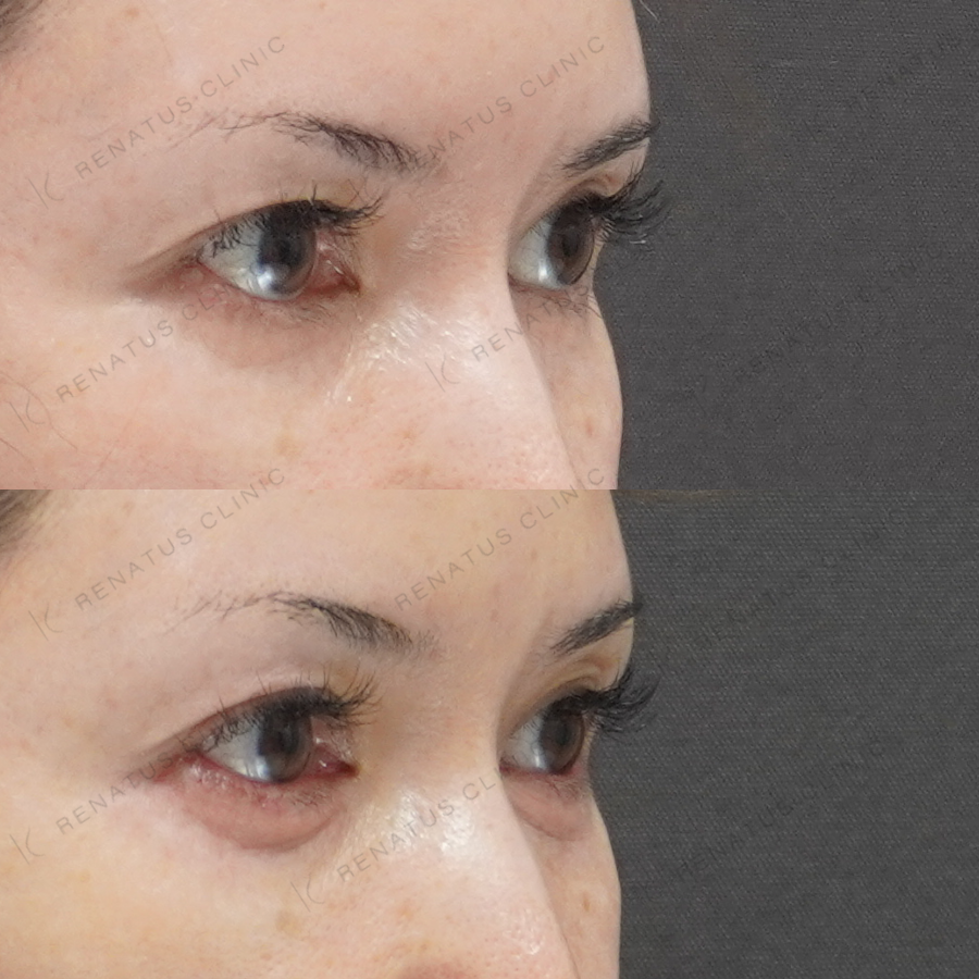 涙袋ヒアルロン酸症例写真