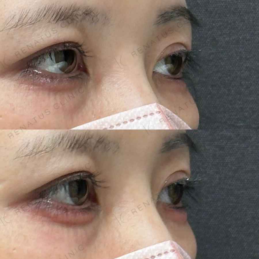 涙袋ヒアルロン酸症例写真