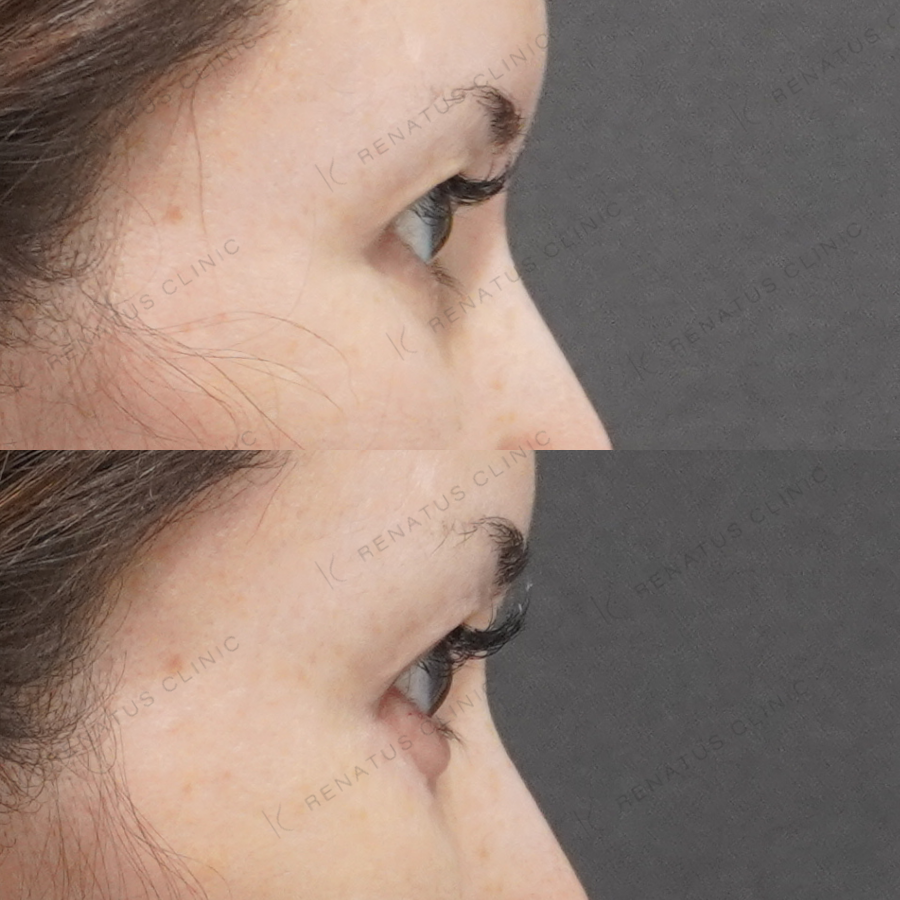 涙袋ヒアルロン酸症例写真