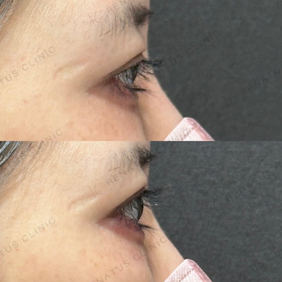 涙袋ヒアルロン酸症例写真