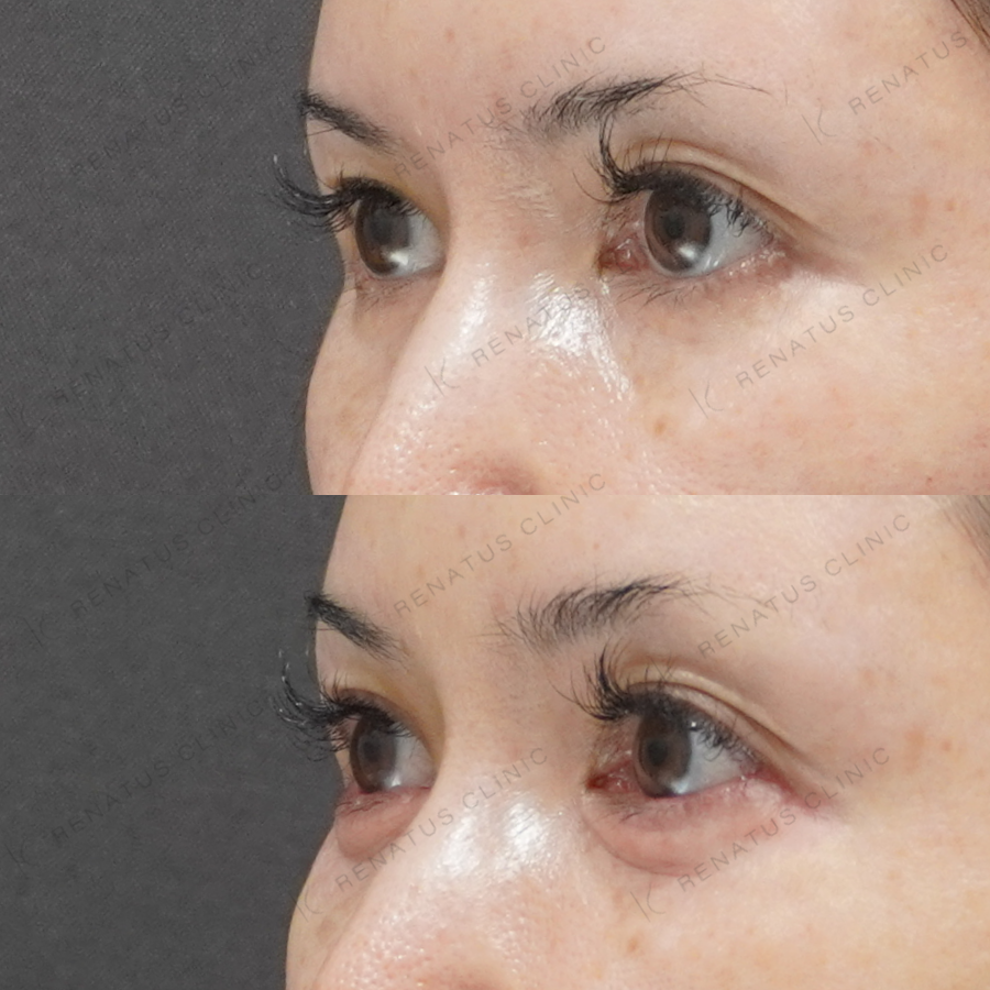 涙袋ヒアルロン酸症例写真