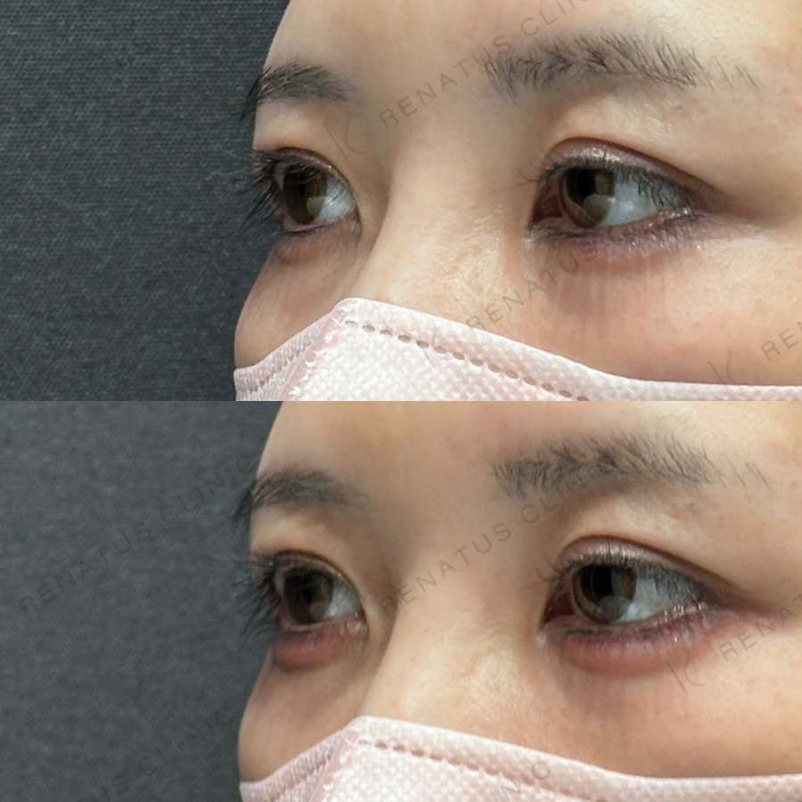 涙袋ヒアルロン酸症例写真