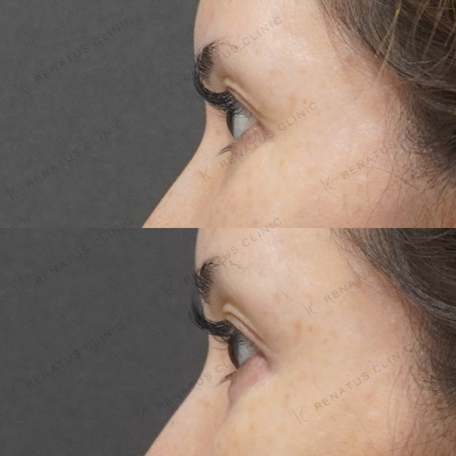 涙袋ヒアルロン酸症例写真