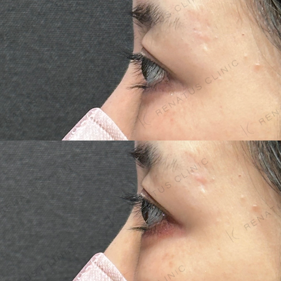 涙袋ヒアルロン酸症例写真