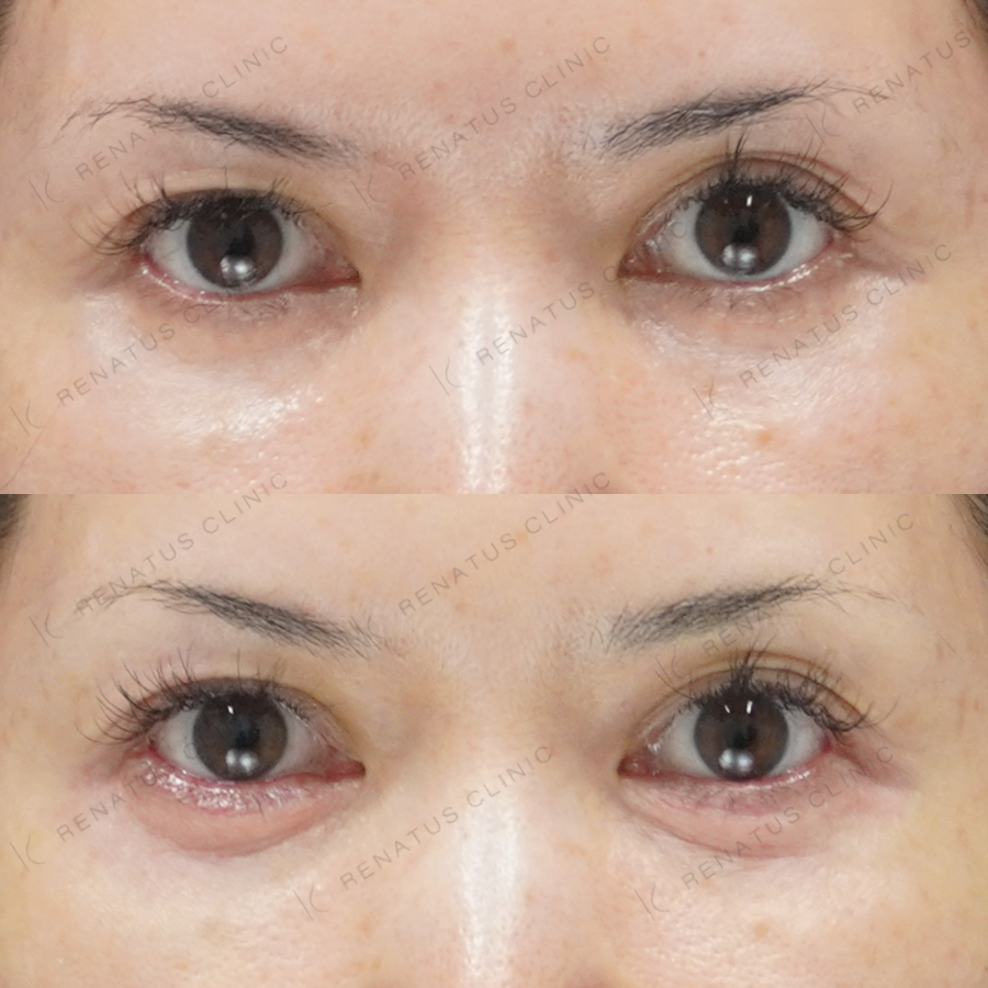 涙袋ヒアルロン酸症例写真