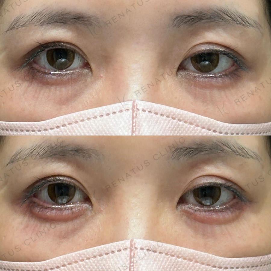 涙袋ヒアルロン酸症例写真