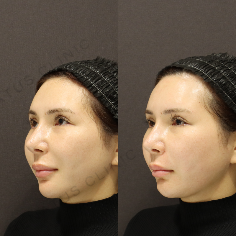 額・頬・鼻翼基部・ほうれい線ヒアルロン酸症例写真