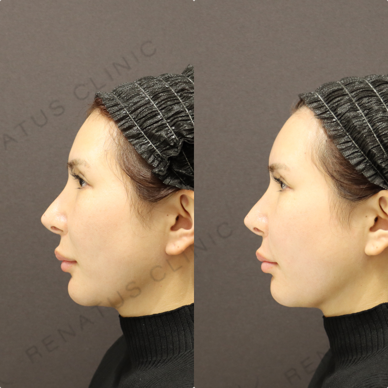 額・頬・鼻翼基部・ほうれい線ヒアルロン酸症例写真