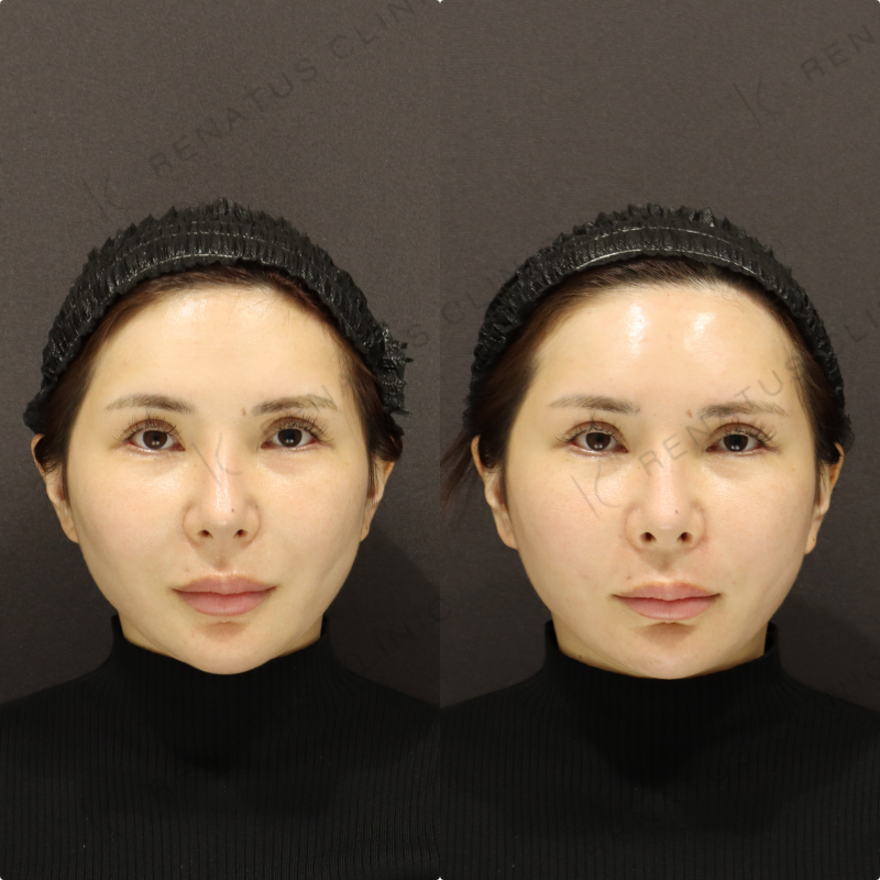 額・頬・鼻翼基部・ほうれい線ヒアルロン酸症例写真