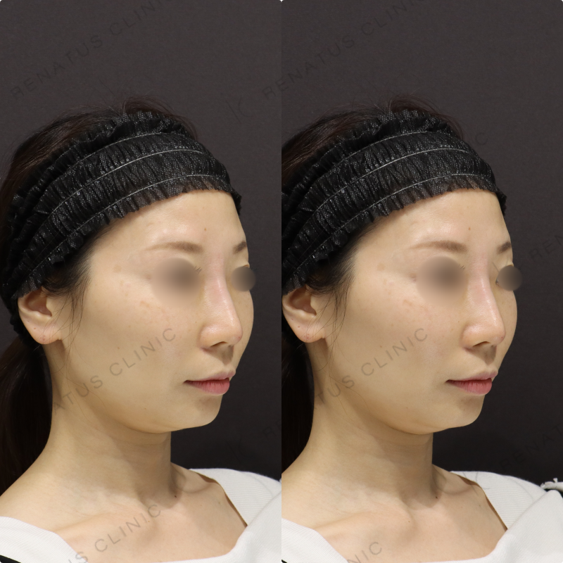 鼻ヒアルロン酸症例写真