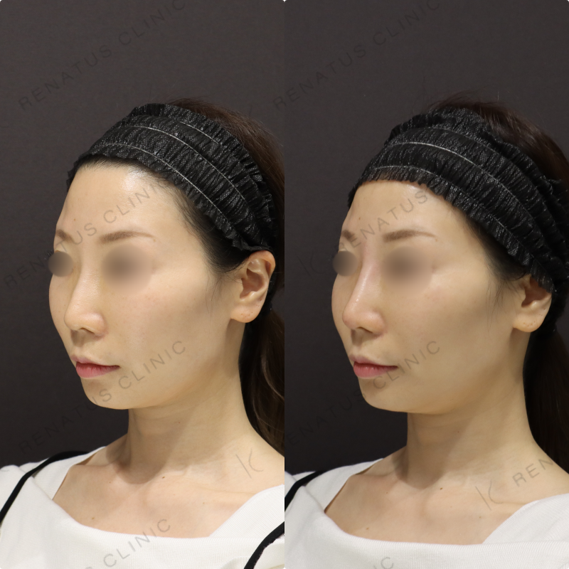 鼻ヒアルロン酸症例写真