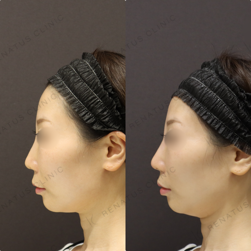 鼻ヒアルロン酸症例写真