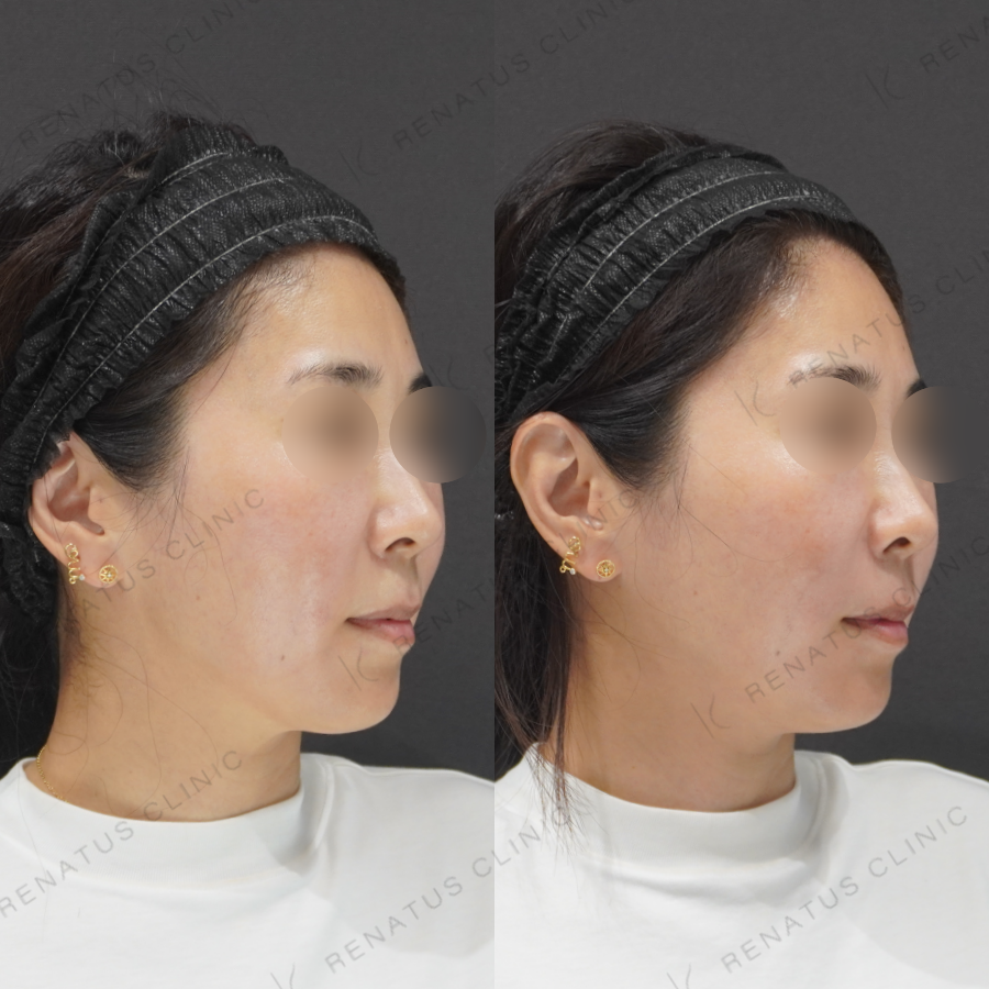 鼻翼基部・ほうれい線症例写真