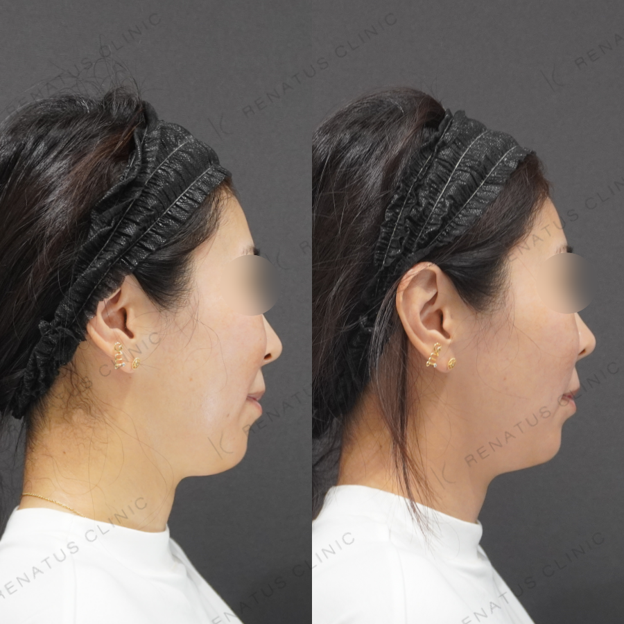 鼻翼基部・ほうれい線症例写真