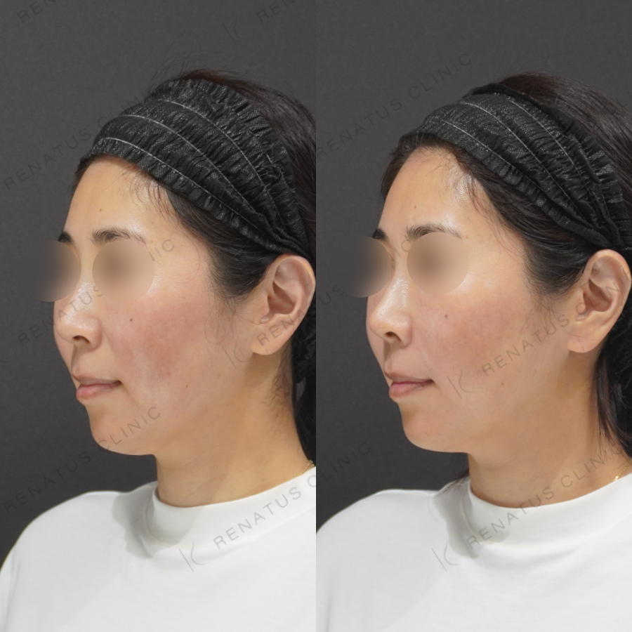 鼻翼基部・ほうれい線症例写真