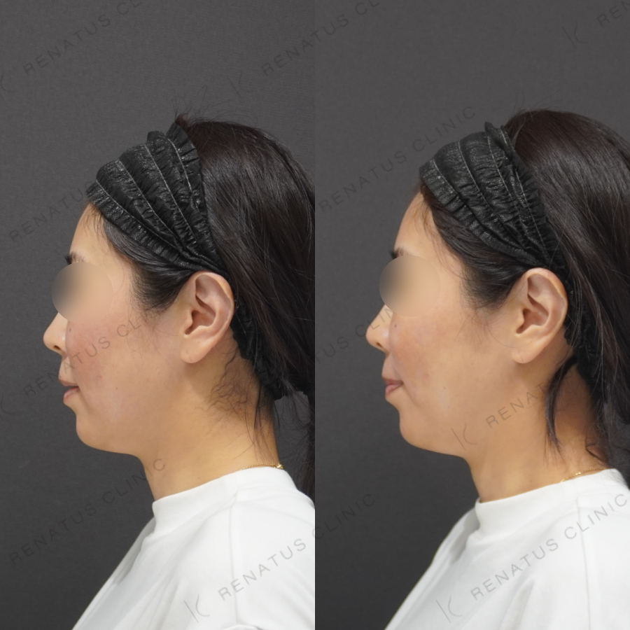 鼻翼基部・ほうれい線症例写真