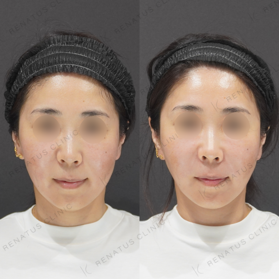 鼻翼基部・ほうれい線症例写真