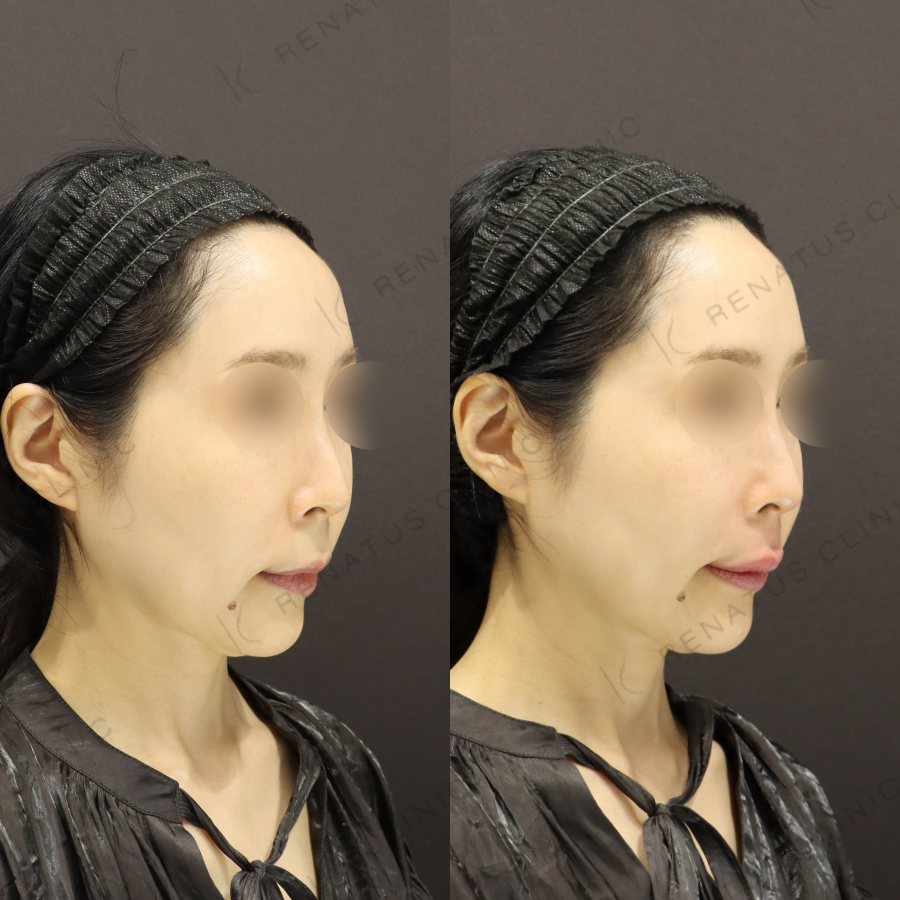 鼻翼基部・上唇ヒアルロン酸症例写真