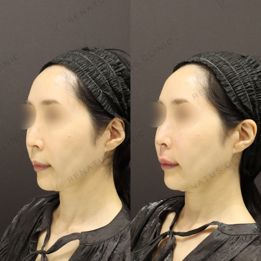 鼻翼基部・上唇ヒアルロン酸症例写真