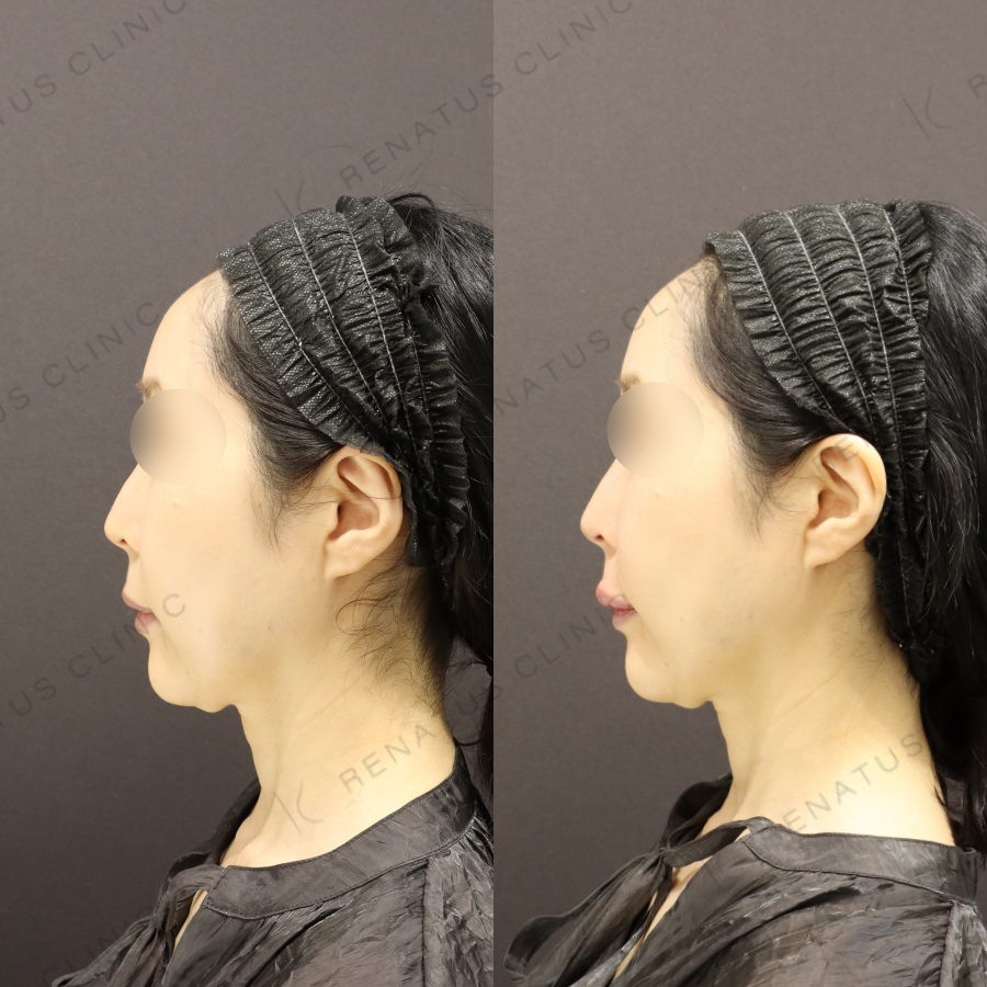 鼻翼基部・上唇ヒアルロン酸症例写真