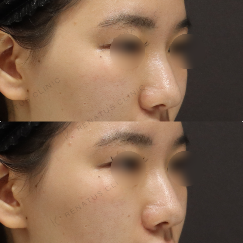 鼻翼基部ヒアルロン酸症例 鼻翼基部ヒアルロン酸症例