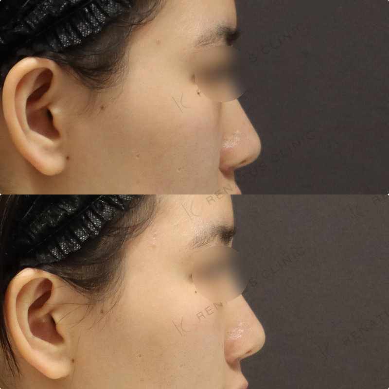 鼻翼基部ヒアルロン酸症例 鼻翼基部ヒアルロン酸症例