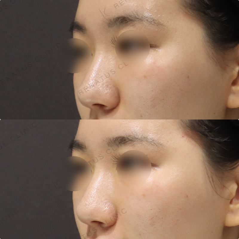 鼻翼基部ヒアルロン酸症例 鼻翼基部ヒアルロン酸症例